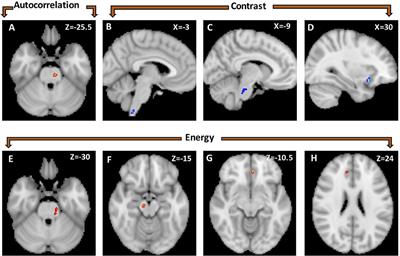MRI Texture Analysis Reveals Brain Abnormalities in Medically Refractory Trigeminal Neuralgia